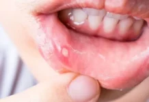 Alarma por la sífilis: aumentan los contagios y el 28% de los hombres ya tuvo la enfermedad